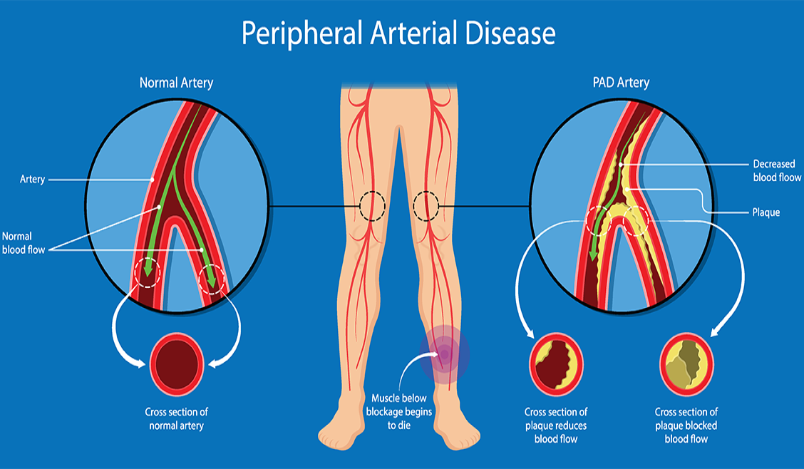 PAD treatment Washington